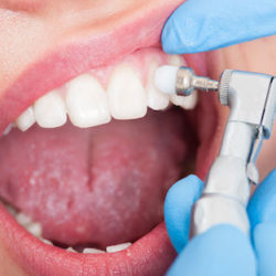 Уникальная процедура БИО гигиены полости рта